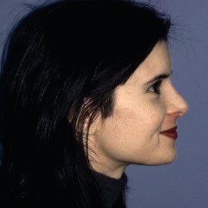 Rhinoplasty Dr. Rein Rhinoplasty Dr. Rein