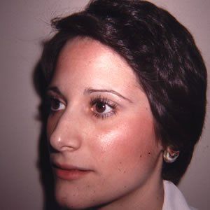 Rhinoplasty Dr. Rein Rhinoplasty Dr. Rein