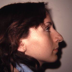 Rhinoplasty Dr. Rein Rhinoplasty Dr. Rein