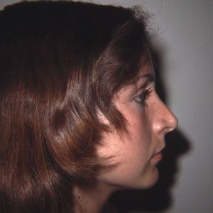 Rhinoplasty Dr. Rein Rhinoplasty Dr. Rein