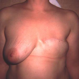 Breast Reconstruction Dr. Joel Rein Breast Reconstruction Dr. Joel Rein