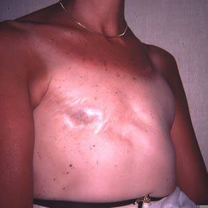 Breast Reconstruction Dr. Joel Rein Breast Reconstruction Dr. Joel Rein