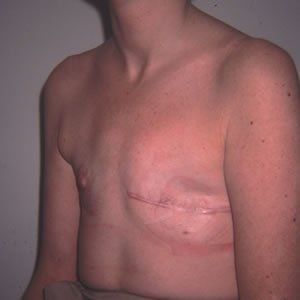 Breast Reconstruction Dr. Joel Rein Breast Reconstruction Dr. Joel Rein