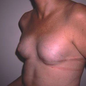 Breast Anomalies Dr. Joel Rein Breast Anomalies Dr. Joel Rein
