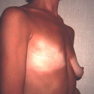 Breast Reconstruction Dr. Joel Rein Breast Reconstruction Dr. Joel Rein