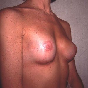 Breast Reconstruction Dr. Joel Rein Breast Reconstruction Dr. Joel Rein