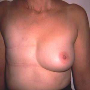 Breast Reconstruction Dr. Joel Rein Breast Reconstruction Dr. Joel Rein