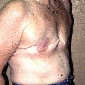 Breast Reconstruction Dr. Joel Rein