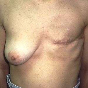 Breast Reconstruction Dr. Joel Rein Breast Reconstruction Dr. Joel Rein