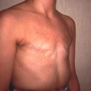 Breast Reconstruction Dr. Joel Rein Breast Reconstruction Dr. Joel Rein