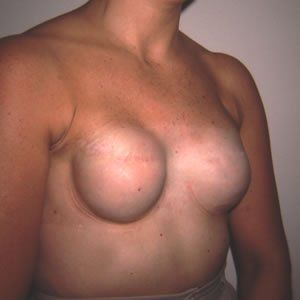 Breast Reconstruction Dr. Joel Rein Breast Reconstruction Dr. Joel Rein