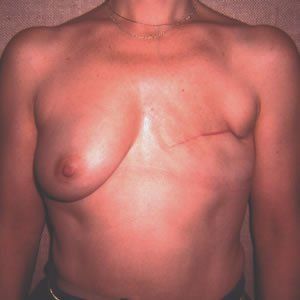 Breast Reconstruction Dr. Joel Rein Breast Reconstruction Dr. Joel Rein