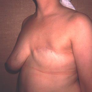 Breast Reconstruction Dr. Joel Rein Breast Reconstruction Dr. Joel Rein