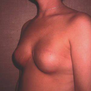 Breast Reconstruction Dr. Joel Rein Breast Reconstruction Dr. Joel Rein