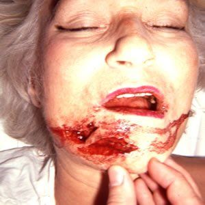 Trauma Injury Dr. Joel Rein Trauma Injury Dr. Joel Rein