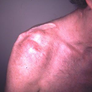 Breast Reconstruction Dr. Joel Rein Breast Reconstruction Dr. Joel Rein