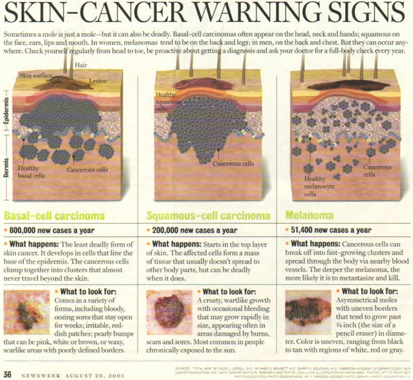 Skin Cancer Warning Signs