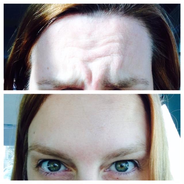 Botox Dr. Joel Rein Botox Dr. Joel Rein