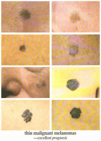 Thin Malignant Melanomas