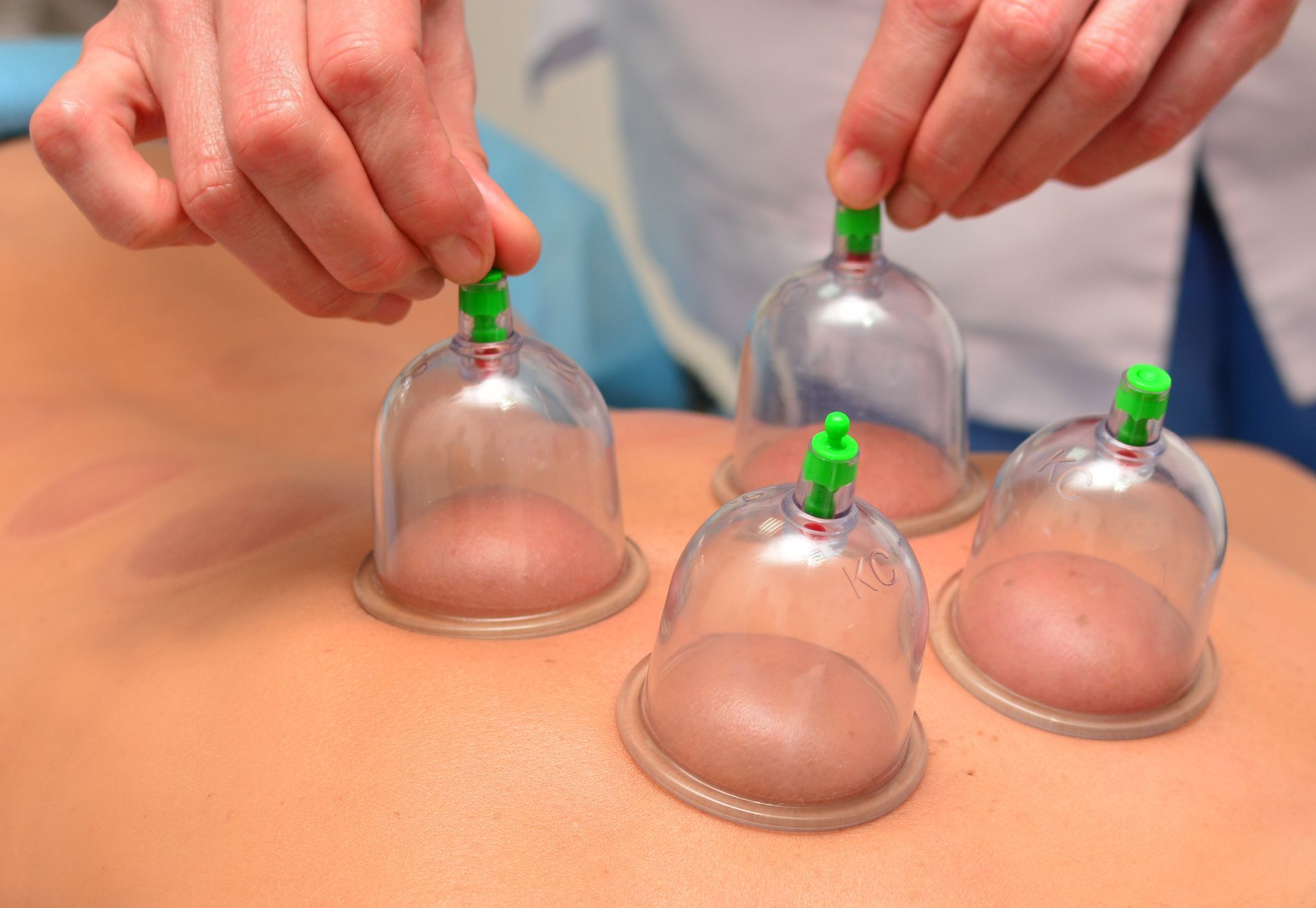 Cupping therapy