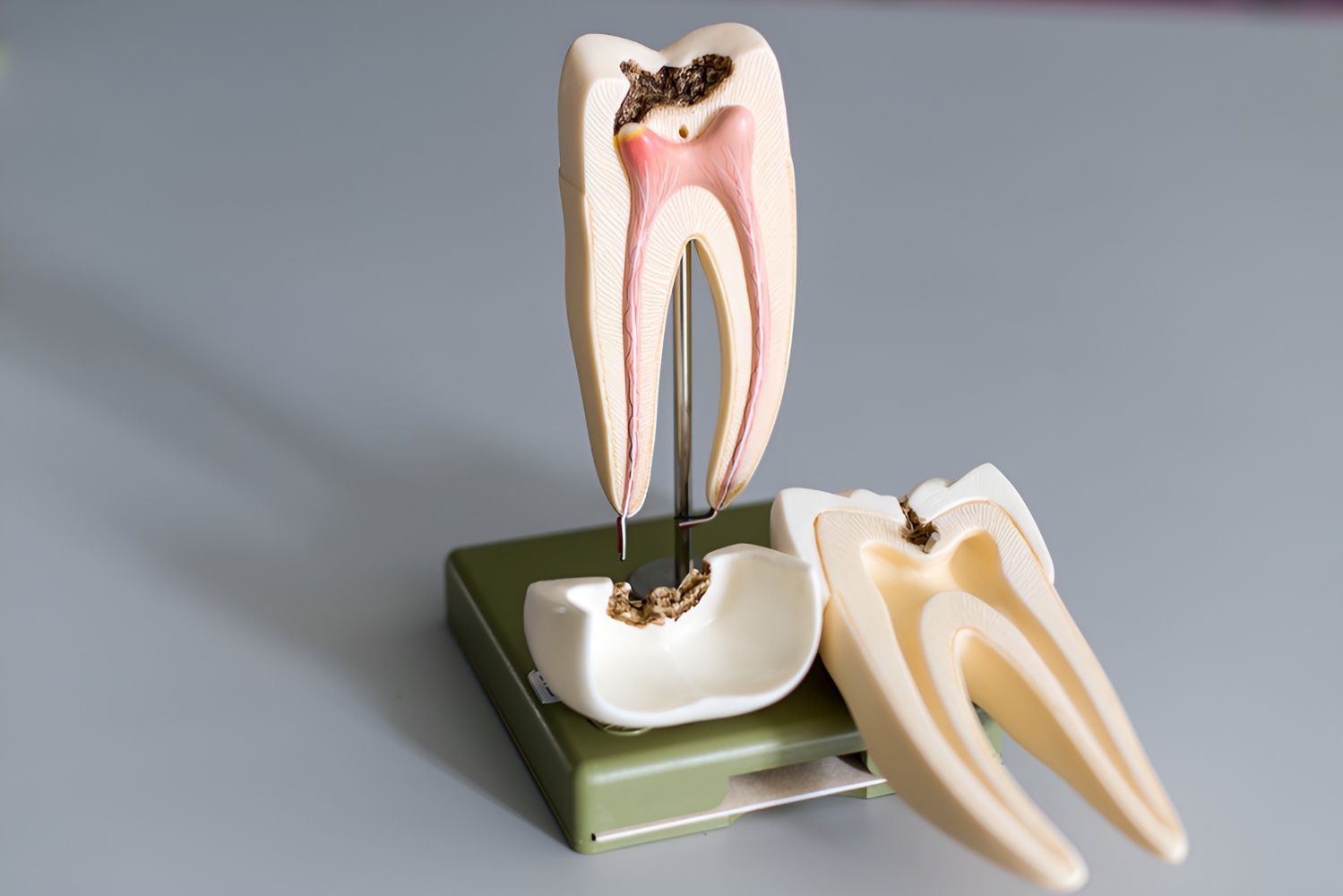 A Model of a Tooth With a Hole in It — Tweed Banora Dental In Tweed Heads South, NSW