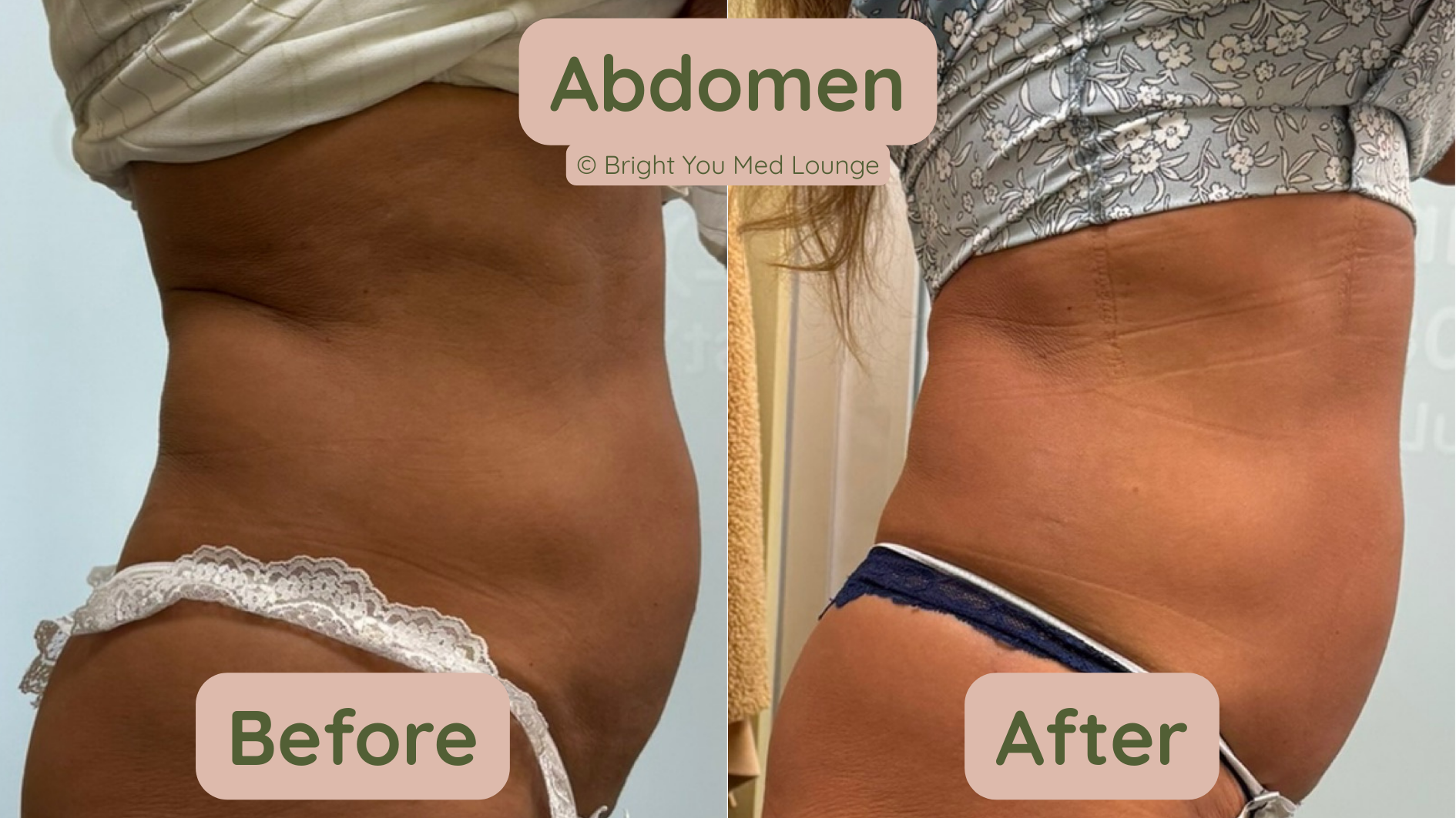 Side-by-side comparison of a person's abdomen, before and after a treatment, showing a reduction in fat.