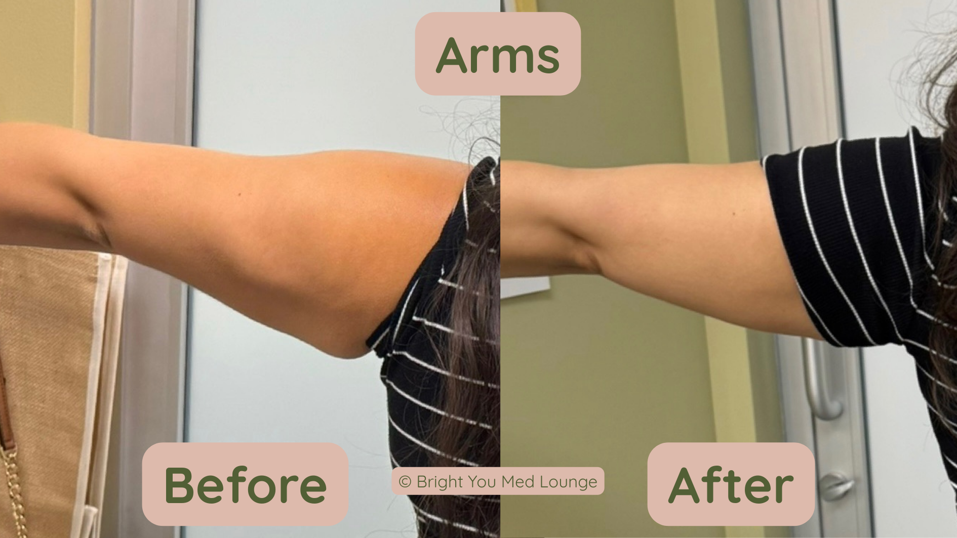 Side-by-side comparison: before and after arms. The 