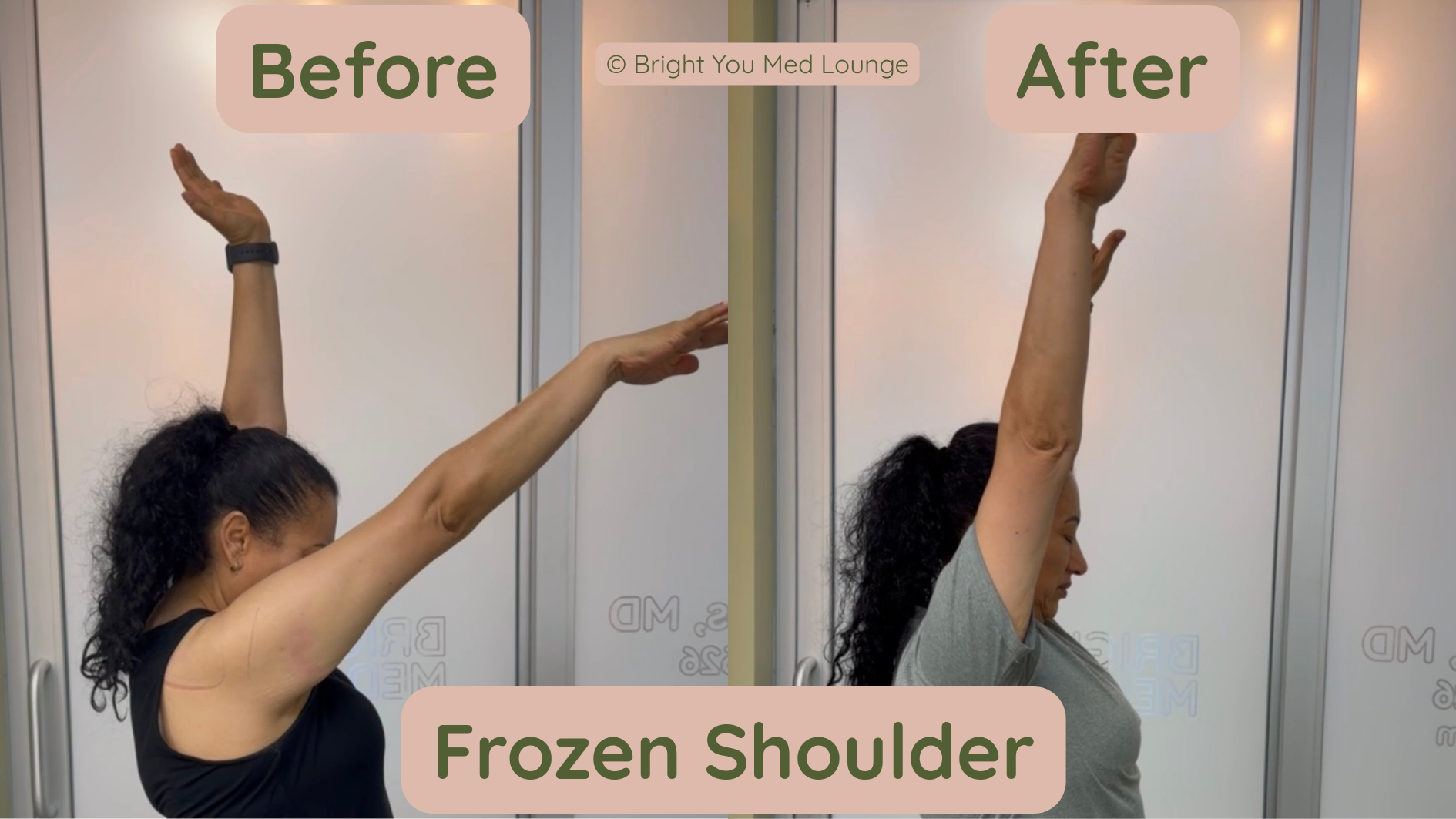 Comparison of arm reach before and after frozen shoulder treatment. The 