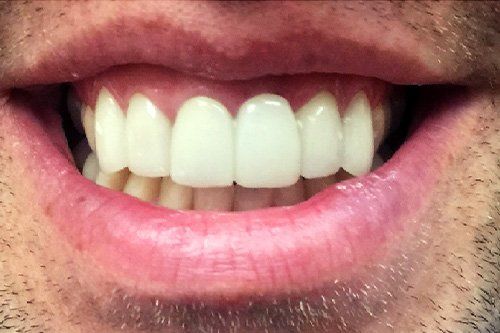 After Teeth Whitening