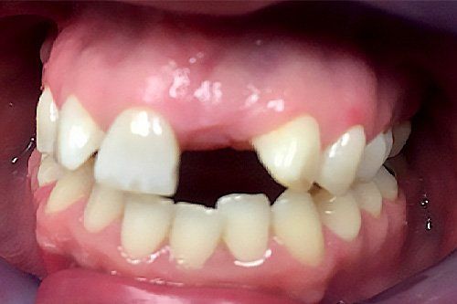 Before Teeth Whitening