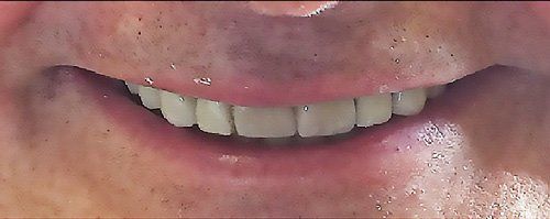 After Dental Implants