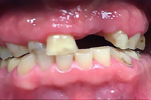 Before Dental Implants