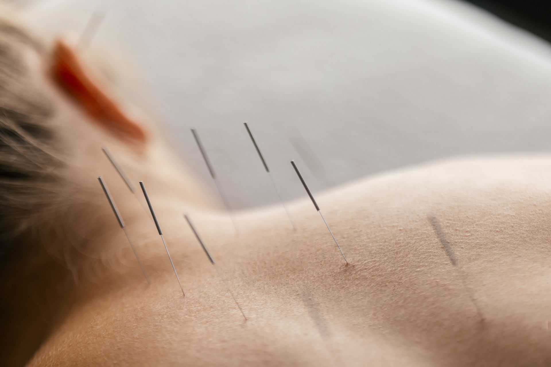 Close-up of a person's back with several acupuncture needles inserted along the neck and upper back.