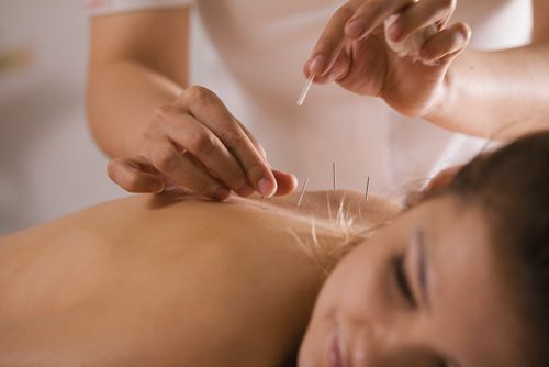 A person receiving acupuncture on their back. Needles are inserted by a practitioner.