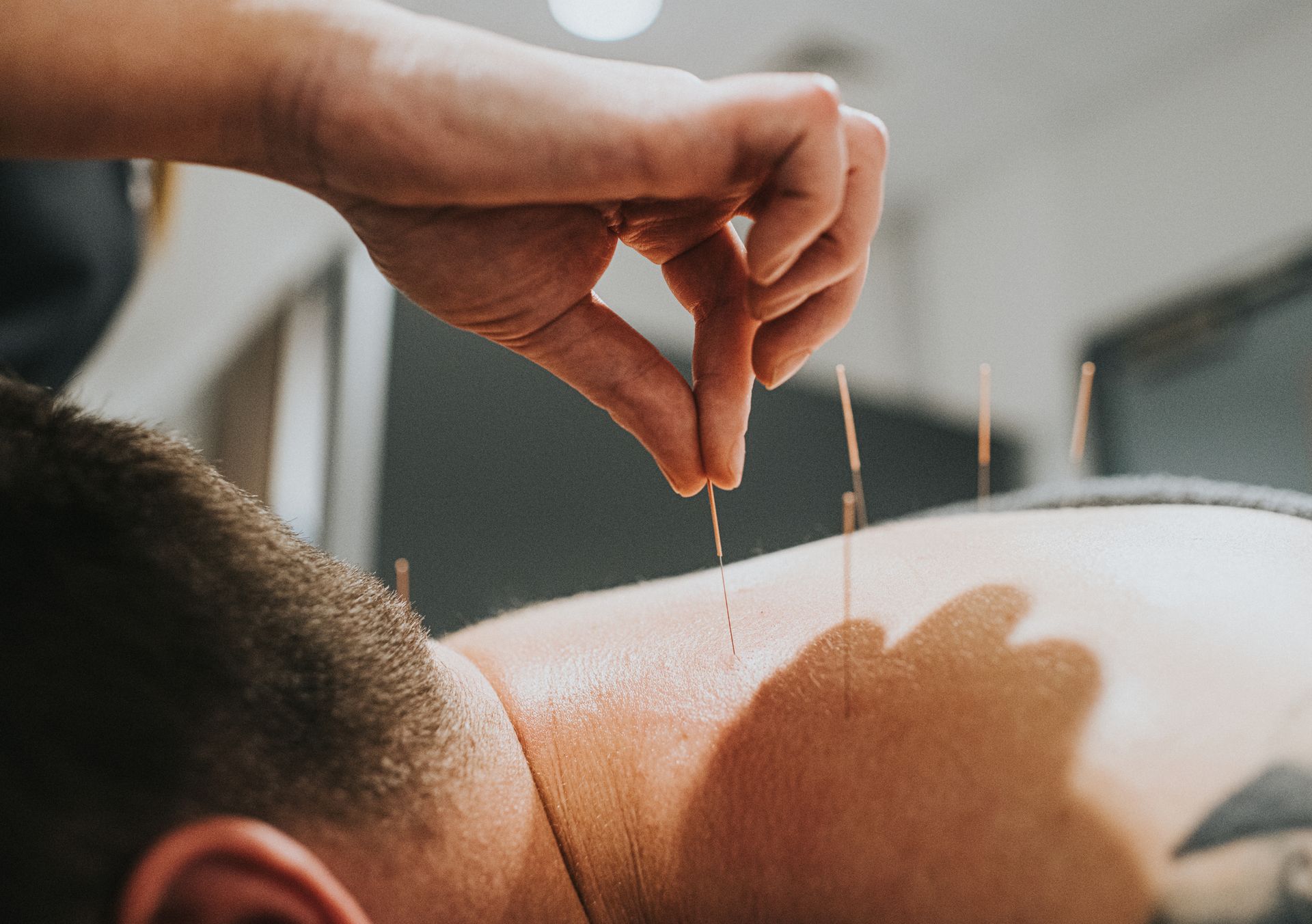 A person receiving acupuncture treatment; needles inserted into their back by a hand. Indoor setting.