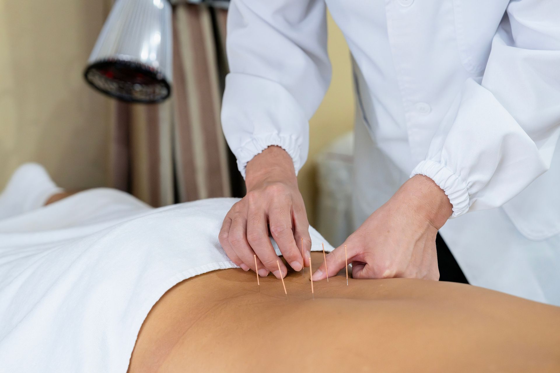 Hands placing acupuncture needles in a person's back, in a medical setting.