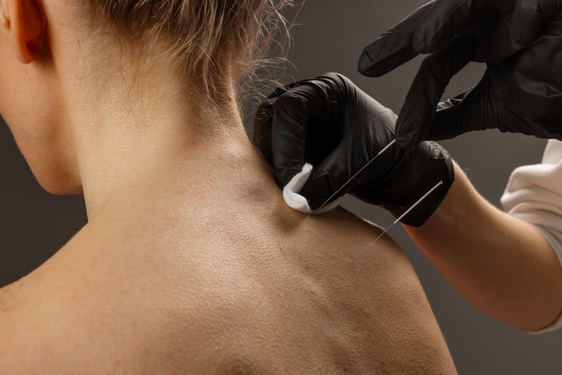 Person's back being treated with a needle; a hand wearing a black glove administers the treatment.