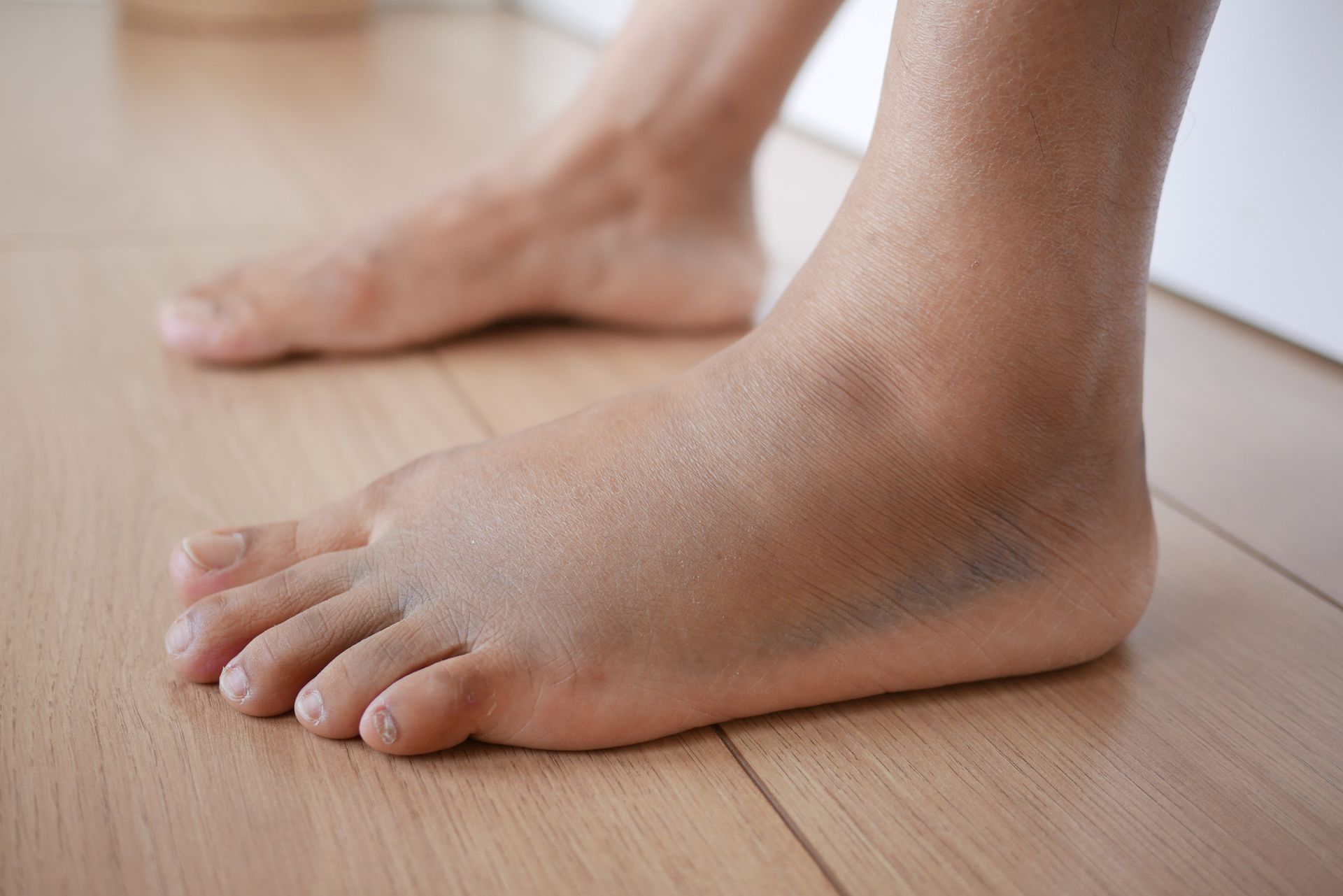 Foot with dark bruising on the side and toes, resting on a wooden floor.