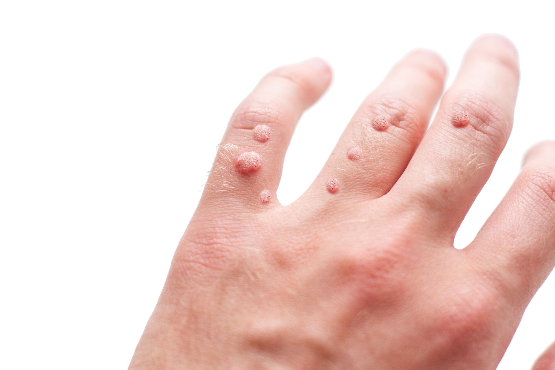 A close up of a person 's hand with warts on it.