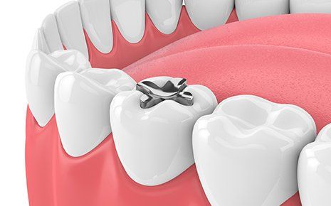 Tooth Filling — Dental Filling in Venice, FL