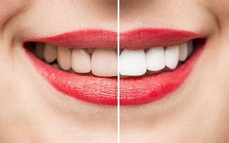 Teeth Whitening — Before and After Whitening in Venice, FL