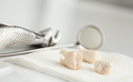Teeth Extractions — Extracted Teeth in Venice, FL