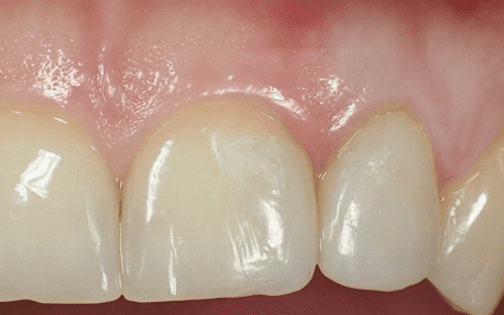 Primo piano degli incisivi superiori e delle gengive rosa, che mostra un piccolo spazio tra i denti.