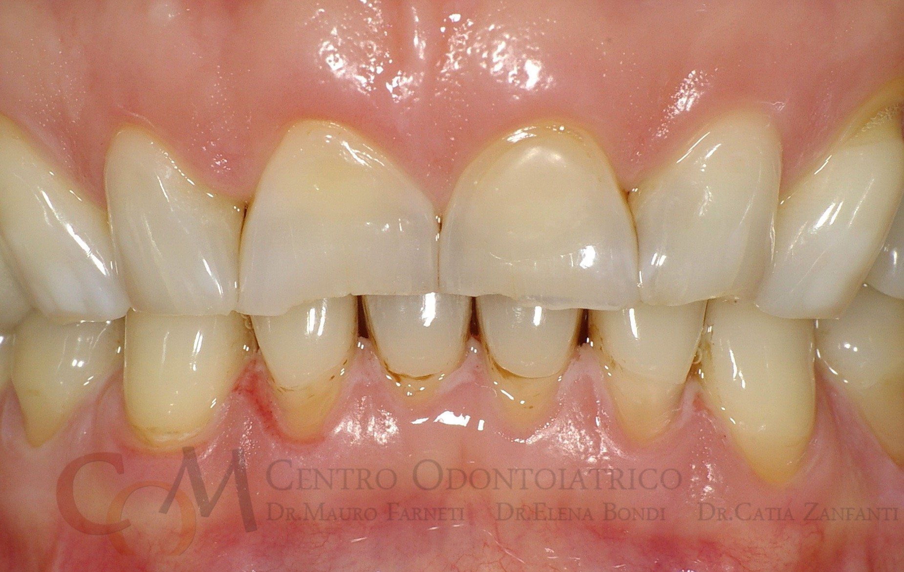 La paziente richiedeva un trattamento conservativo, ma soprattutto invisibile La paziente richiedeva un trattamento conservativo, ma soprattutto invisibile