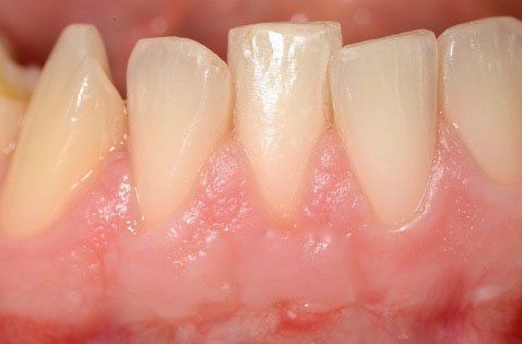 Primo piano di denti e gengive rosa con lieve recessione gengivale.