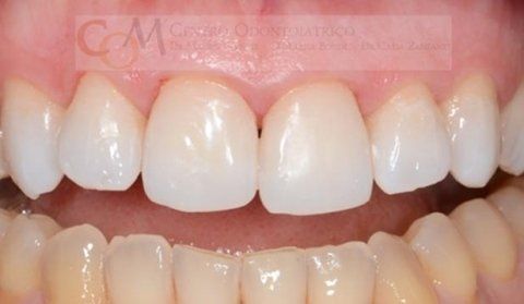 Primo piano dei denti e del sorriso di una persona, che mostra i denti frontali bianchi e brillanti con parte delle gengive visibili.