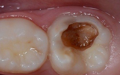 Primo piano di un dente cariato con una grande cavità marrone accanto a un molare sano.