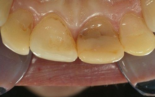 Primo piano dei denti frontali con scolorimento giallo-marrone e divaricatori dentali che tengono la bocca aperta.
