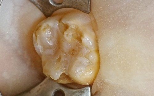 Primo piano di un dente molare con carie e scolorimento.