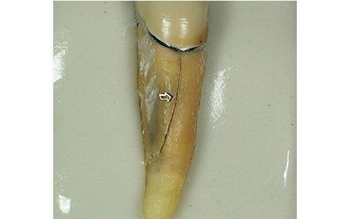 Primo piano di un dente ingiallito e danneggiato con una piccola scheggiatura su sfondo neutro.